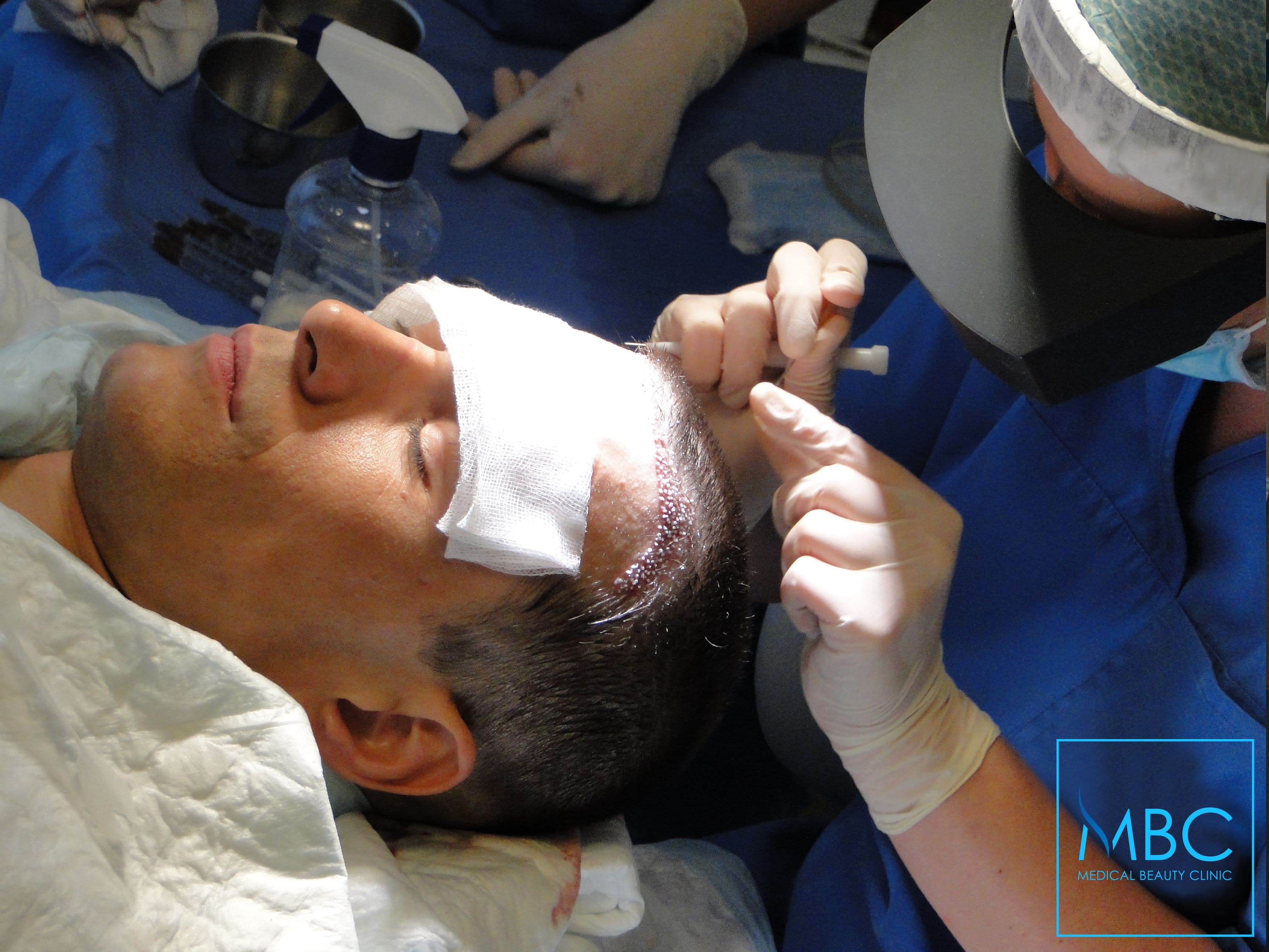 Transplantacija kose Beograd