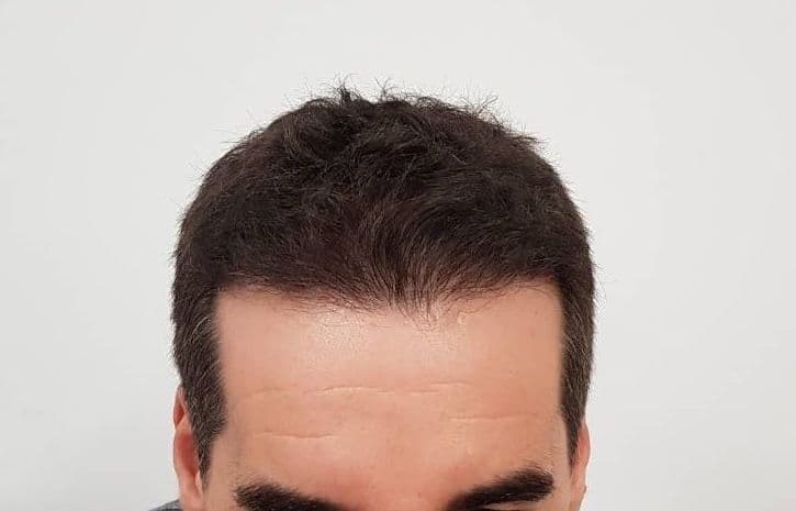 After treatment - Patient 5