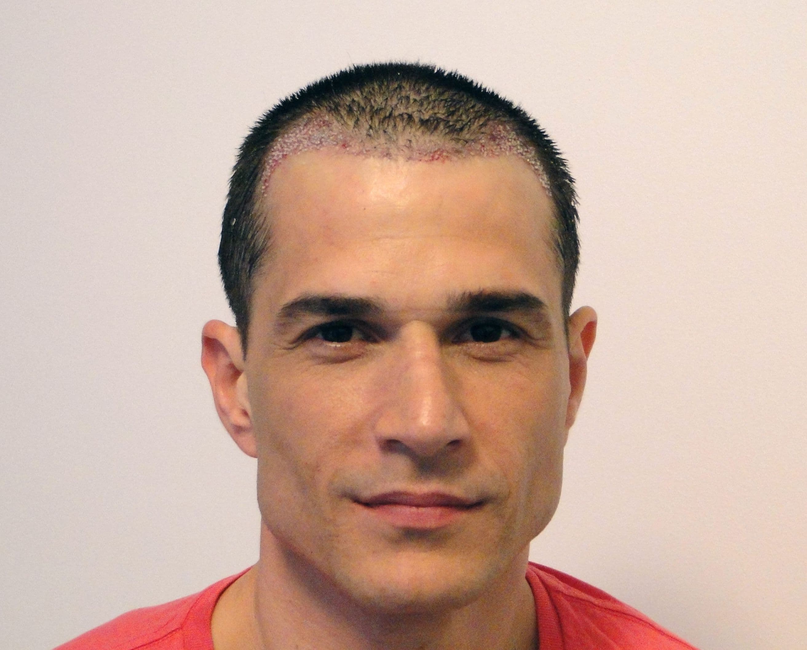 Before treatment - Patient 1