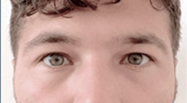 Before treatment - Patient 6