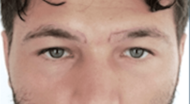 After treatment - Patient 6