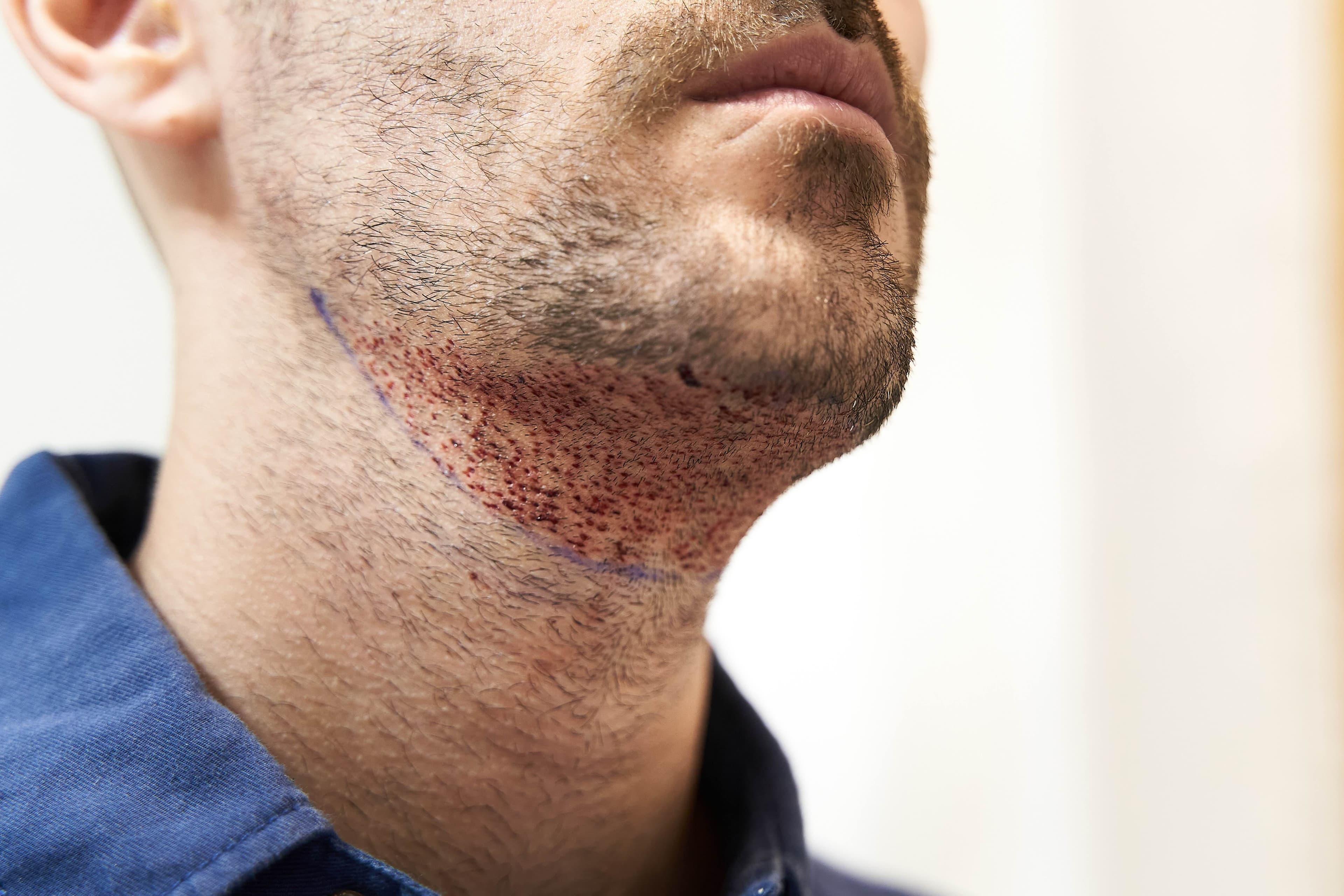 Presađivanje folikula dlake na bradi i vratu