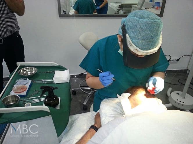 Dr Marija Balkovic izvodi prvu transplantaciju kose FUE metodom u Crnoj Gori