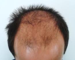 Before treatment - Patient 4