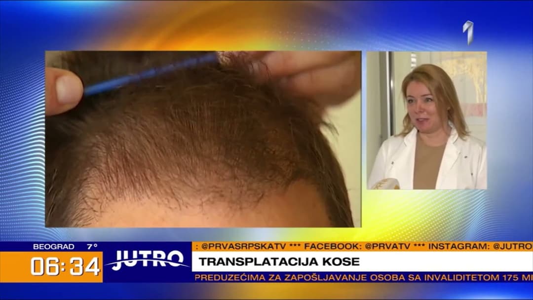FUE Transplantacija Kose - Korak po Korak