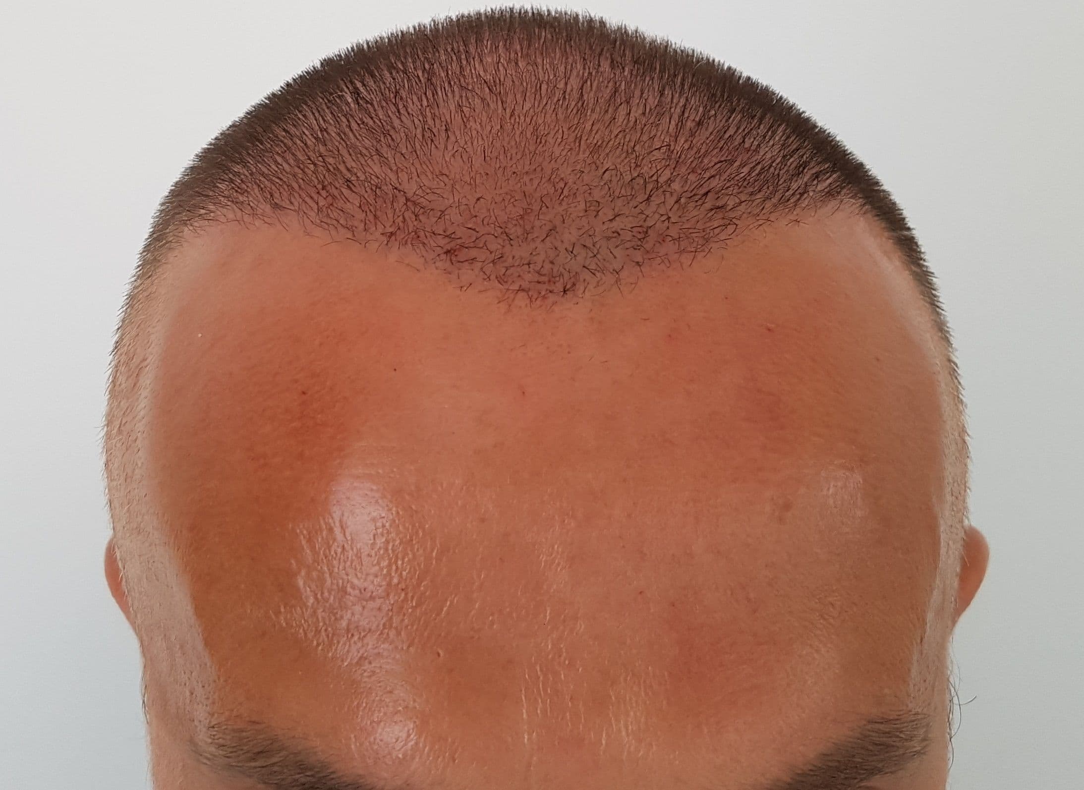 After treatment - Patient 4