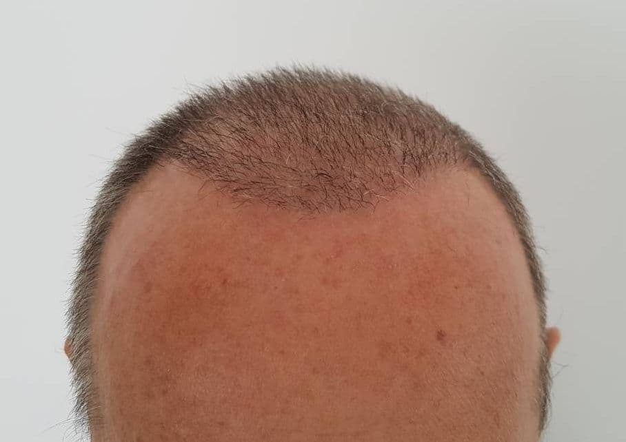 After treatment - Patient 2