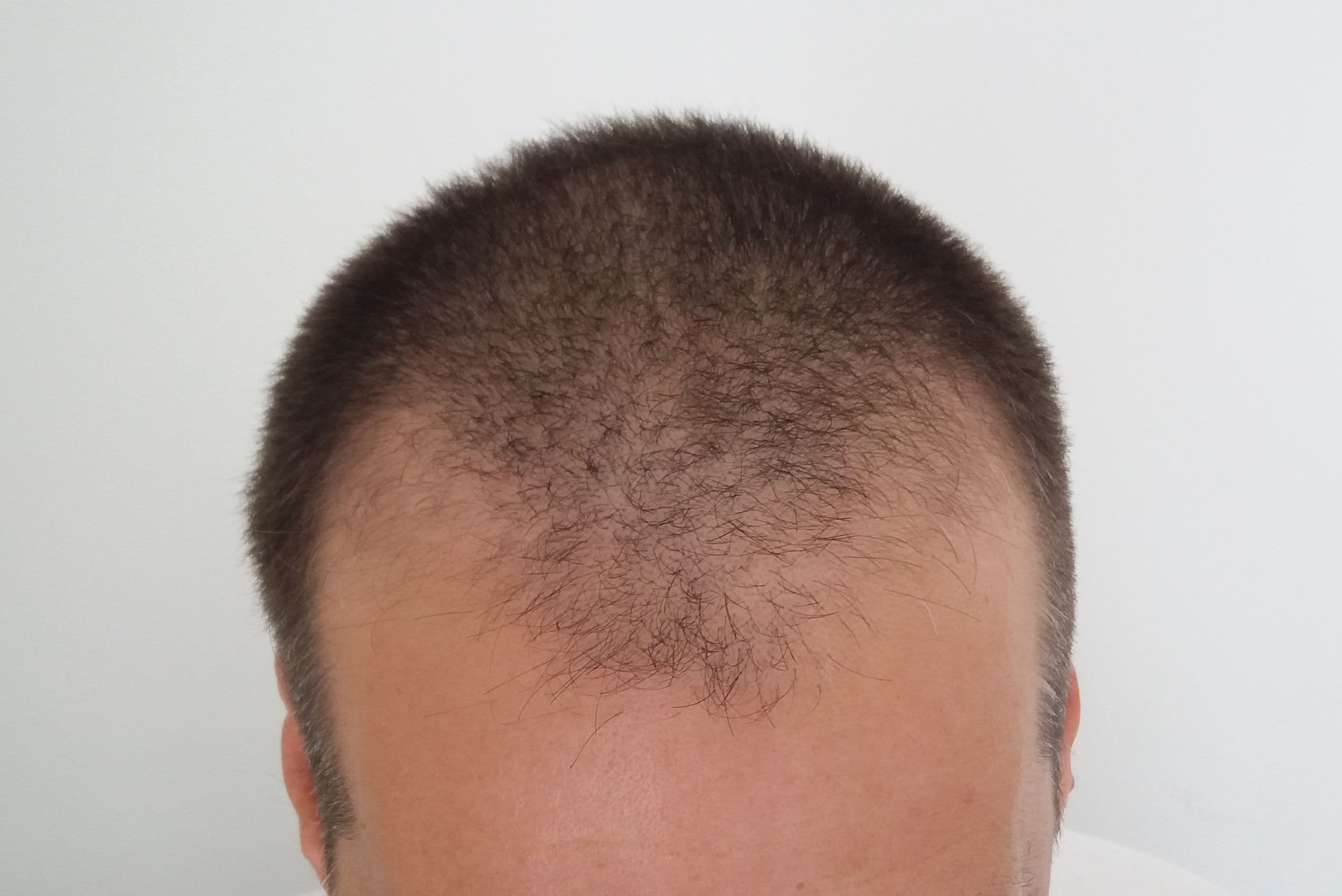 Before treatment - Patient 1