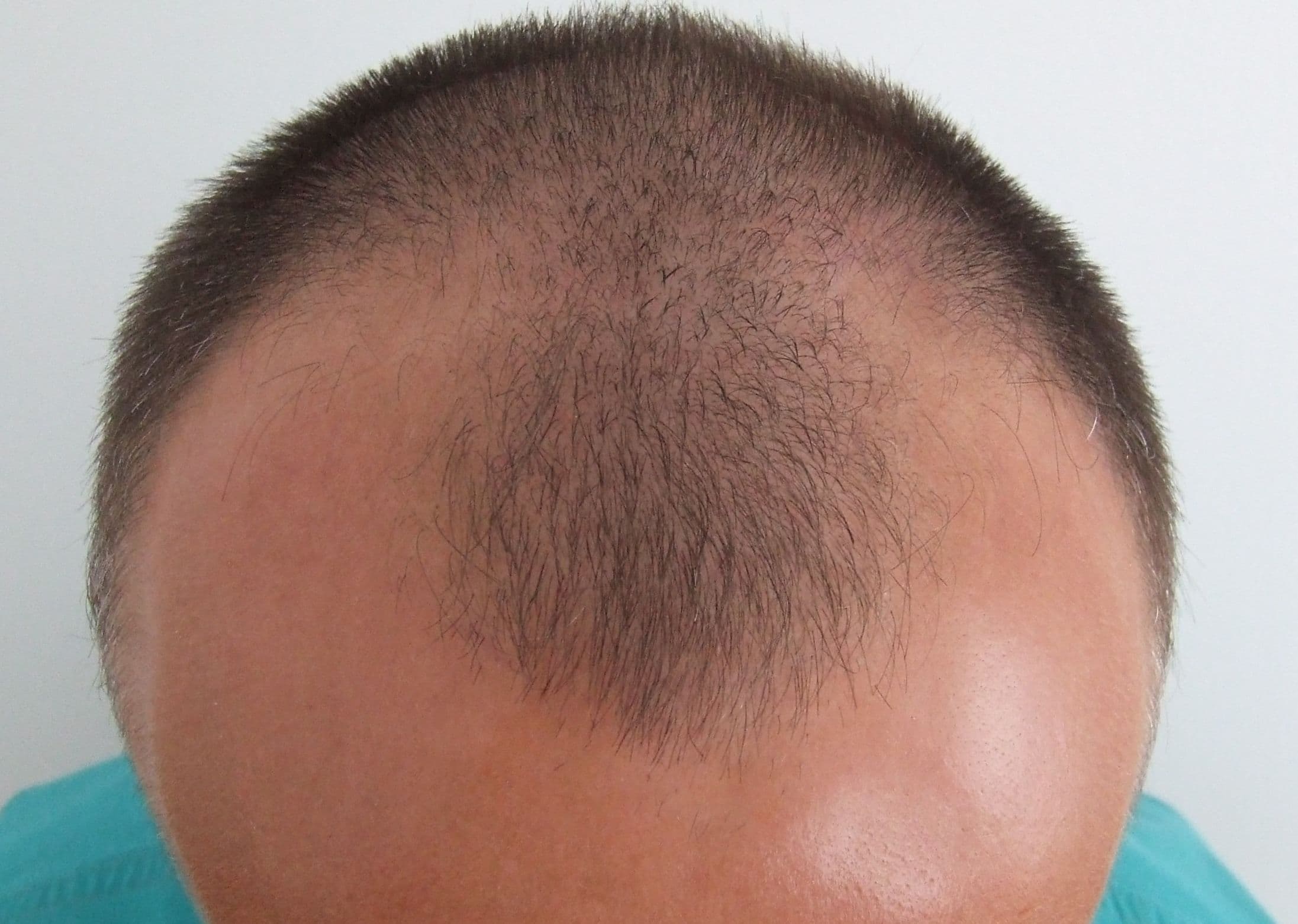 Before treatment - Patient 4