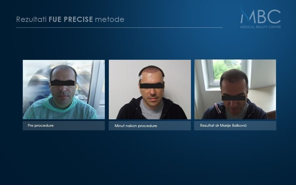pre-i-posle-slika
