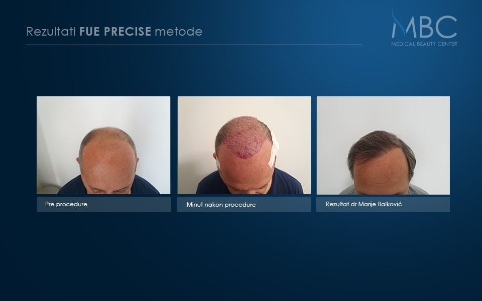 pre-i-posle-slika