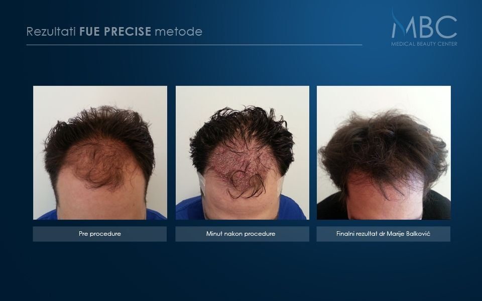 pre-i-posle-slika