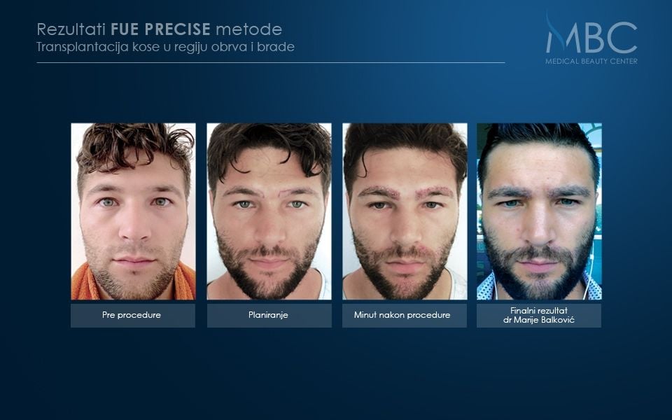 pre-i-posle-slika